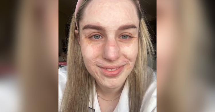 Burn victim Stephanie Coral Browitt smiles proudly as she shows off her face without makeup.