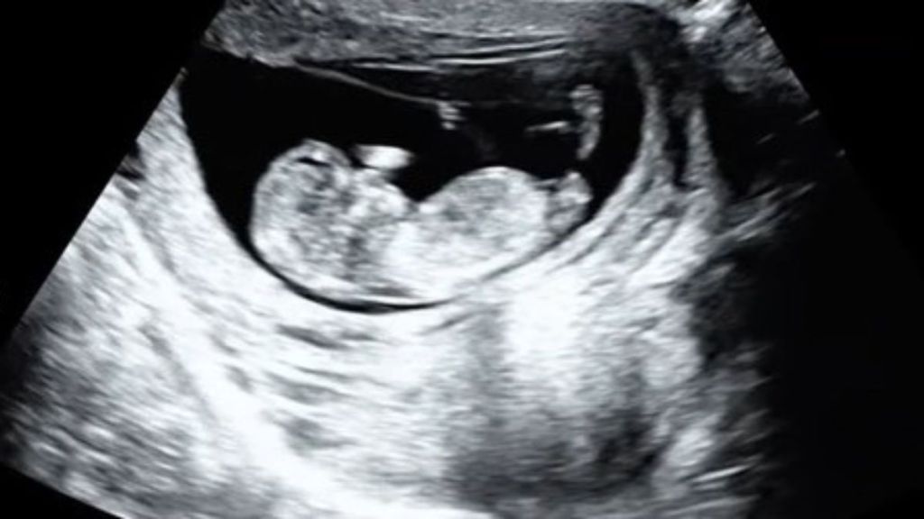 Image shows a developing fetus in an ultrasound image.